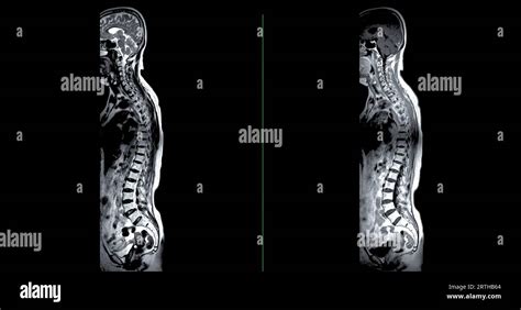 spinal cord compression diagnostic tests|spine compression making you shorter.